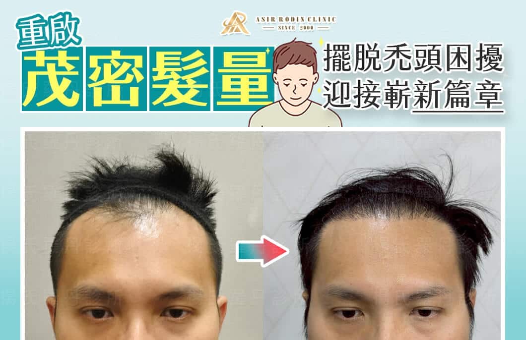 【植髮】擺脫禿頭困擾，重啟茂密髮量迎接人生嶄新篇章