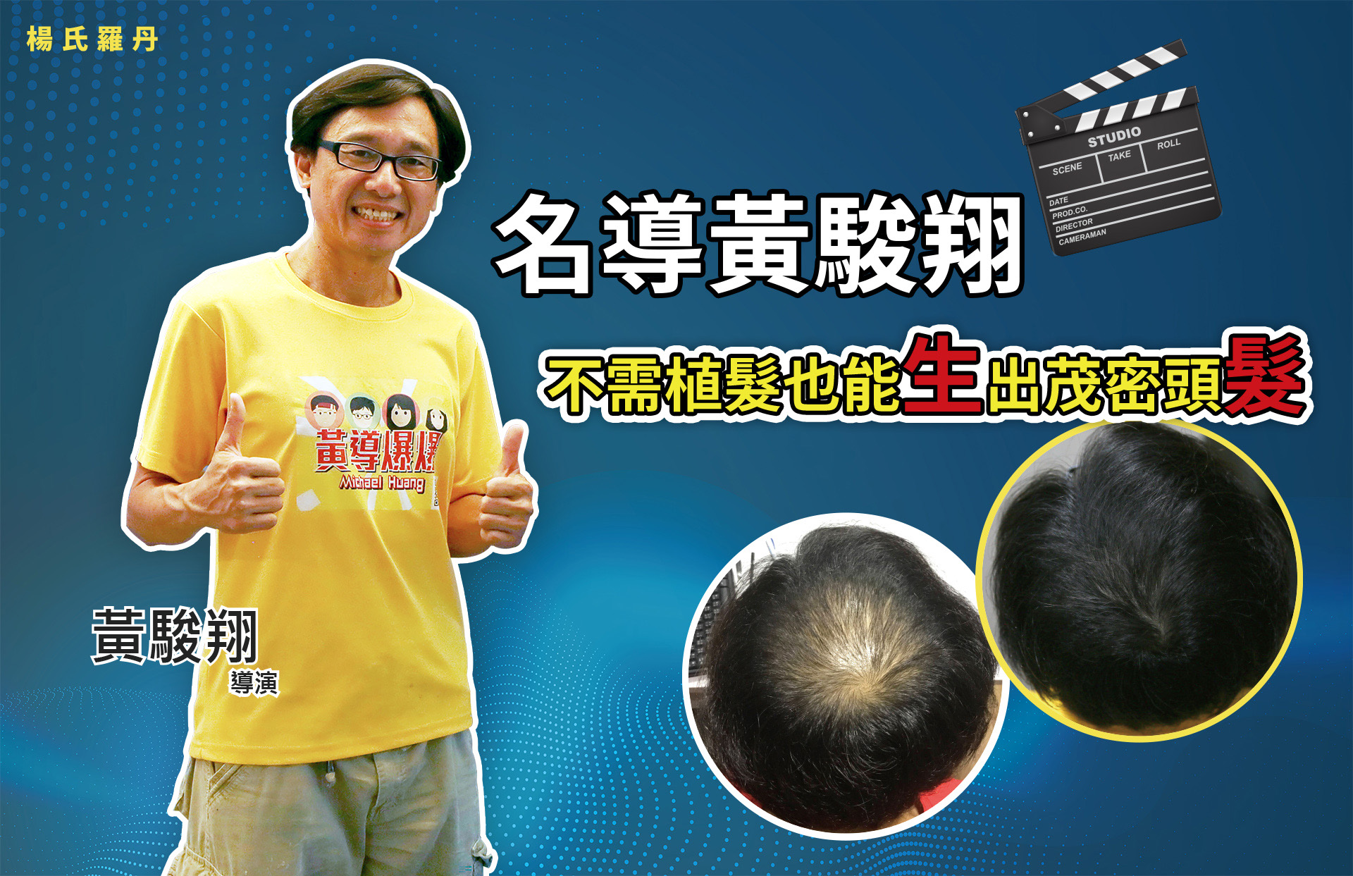 【複合式生髮】重回昔日風采，名導黃駿翔在楊氏羅丹找回茂髮！