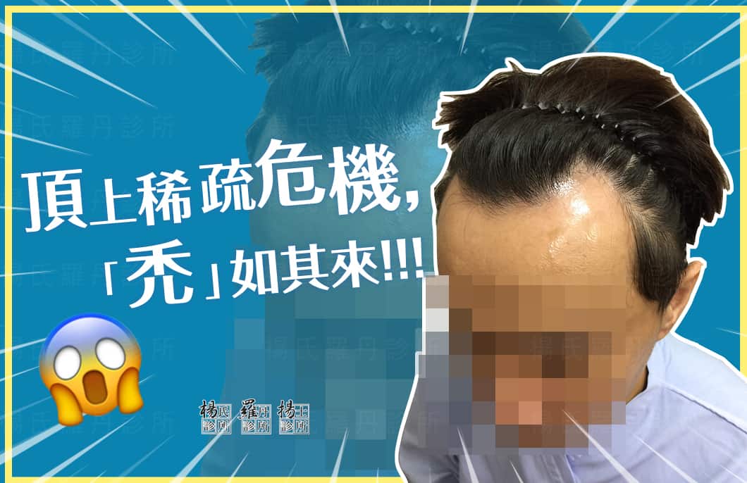 【植髮】頂上稀疏危機，「禿」如期來!!!