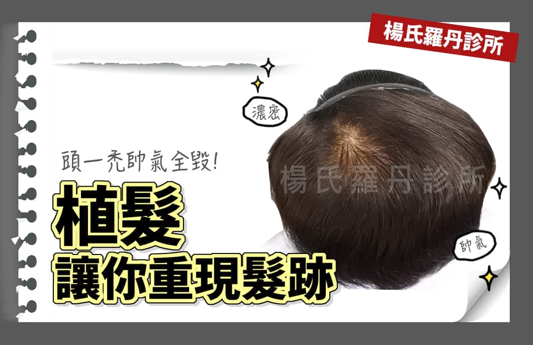 【植髮】頭一禿帥氣全毀！ARTAS植髮讓你重現髮跡