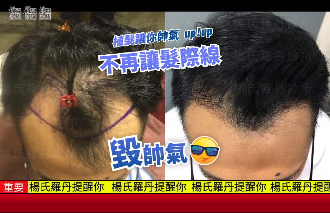 【植髮】不再讓髮際線毀帥氣，植髮讓你帥氣up!up!