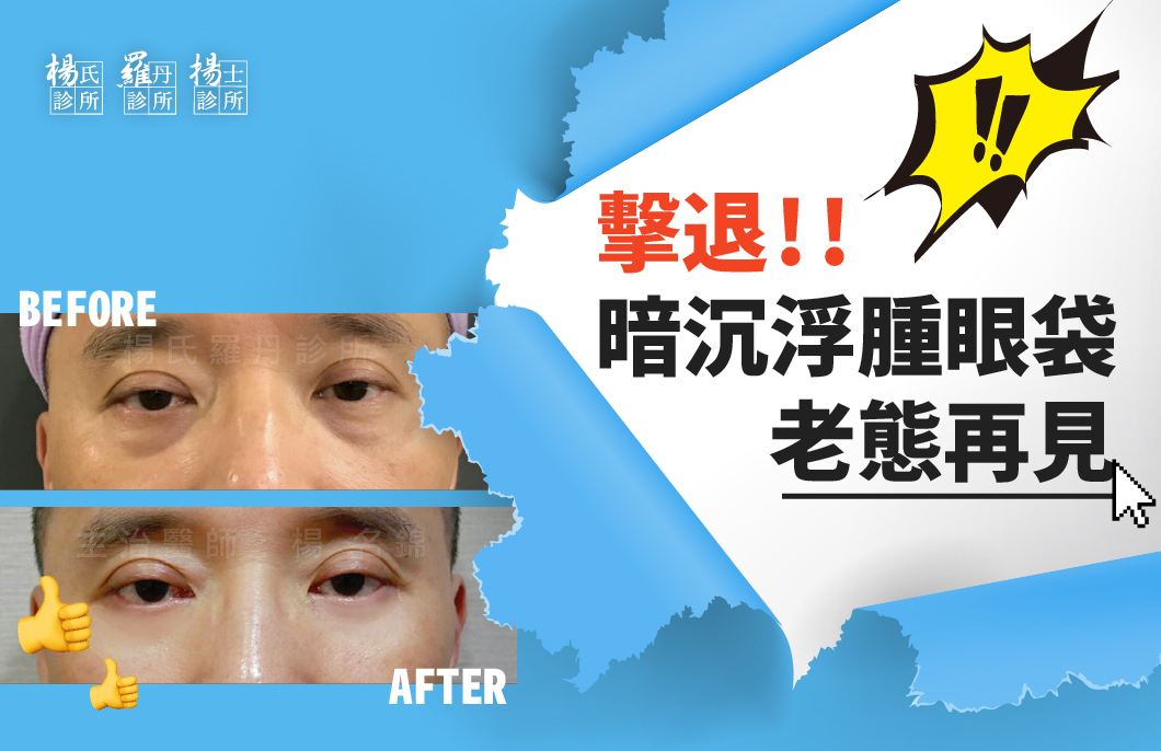 【眼袋贅皮消除】擊退暗沉浮腫眼袋!!老態再見