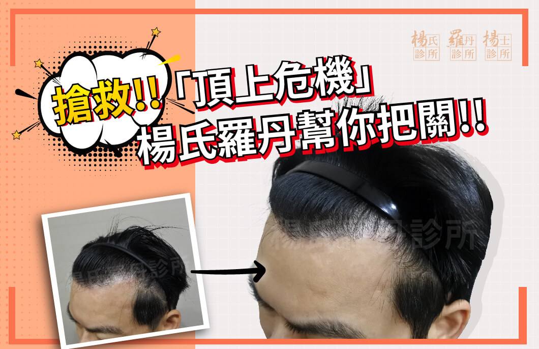【植髮】搶救!!「頂上危機」楊氏羅丹幫你把關
