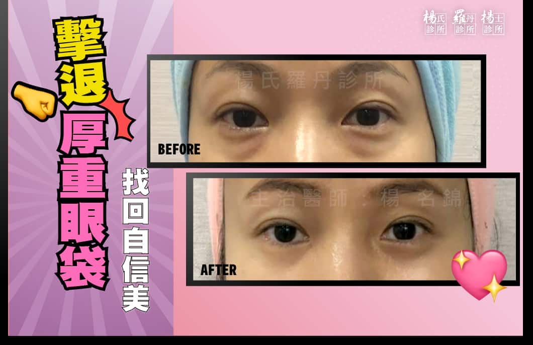 【眼袋淚溝】擊退厚重眼袋！找回自信美