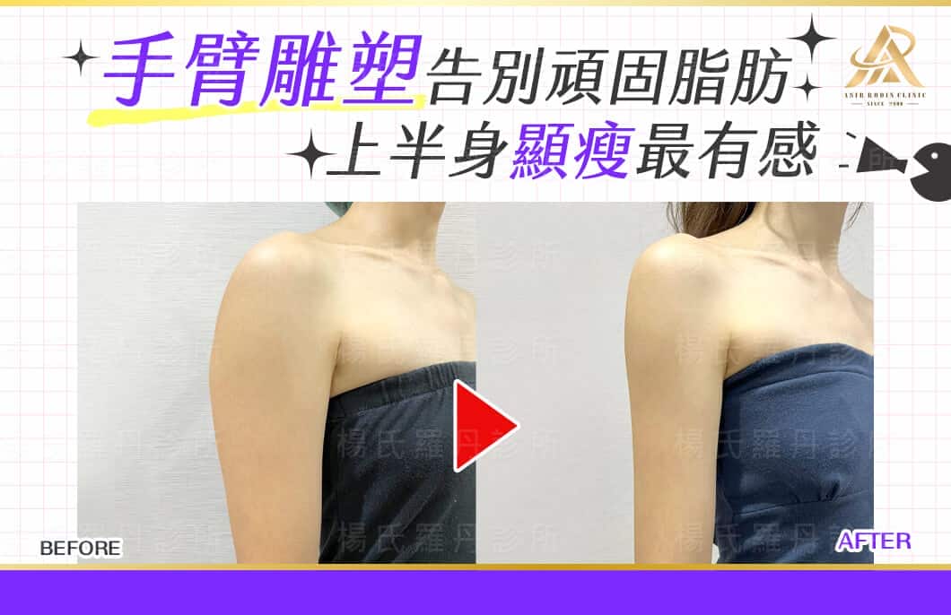 【雷射減脂】手臂雕塑告別頑固脂肪，上半身顯瘦最有感