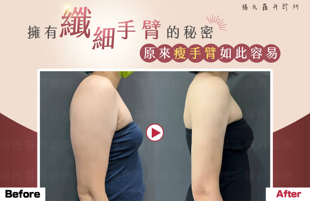 【雷射減脂】擁有纖細手臂的秘密，原來瘦手臂如此容易