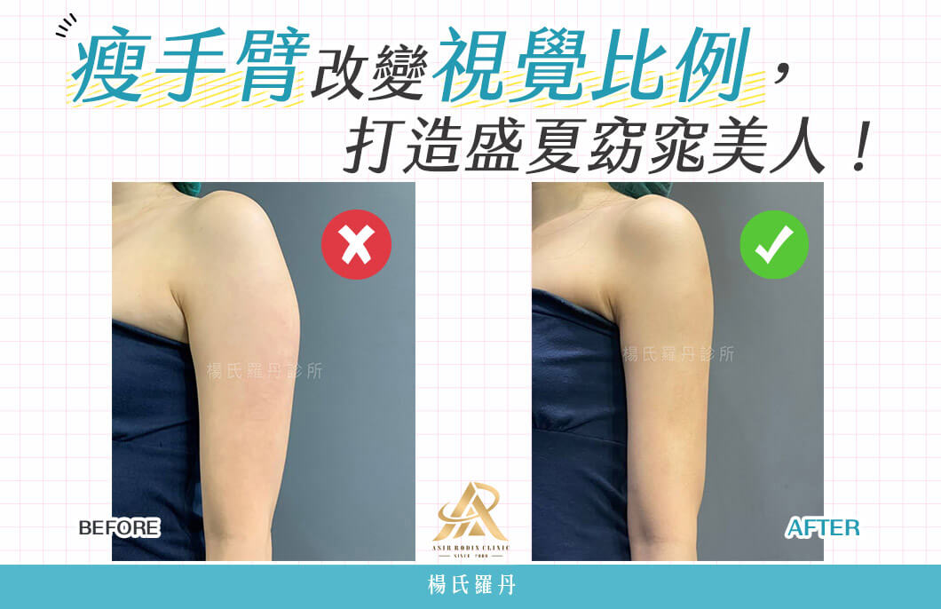 【雷射減脂】瘦手臂改變視覺比例，打造盛夏窈窕美人！