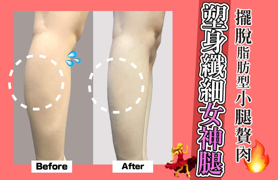 【雷射減脂】擺脫脂肪型小腿贅肉，塑身纖細曲線女神腿