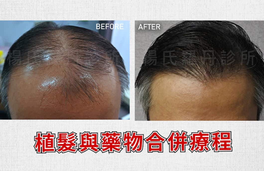 【楊氏羅丹】植髮與藥物合併療程！
