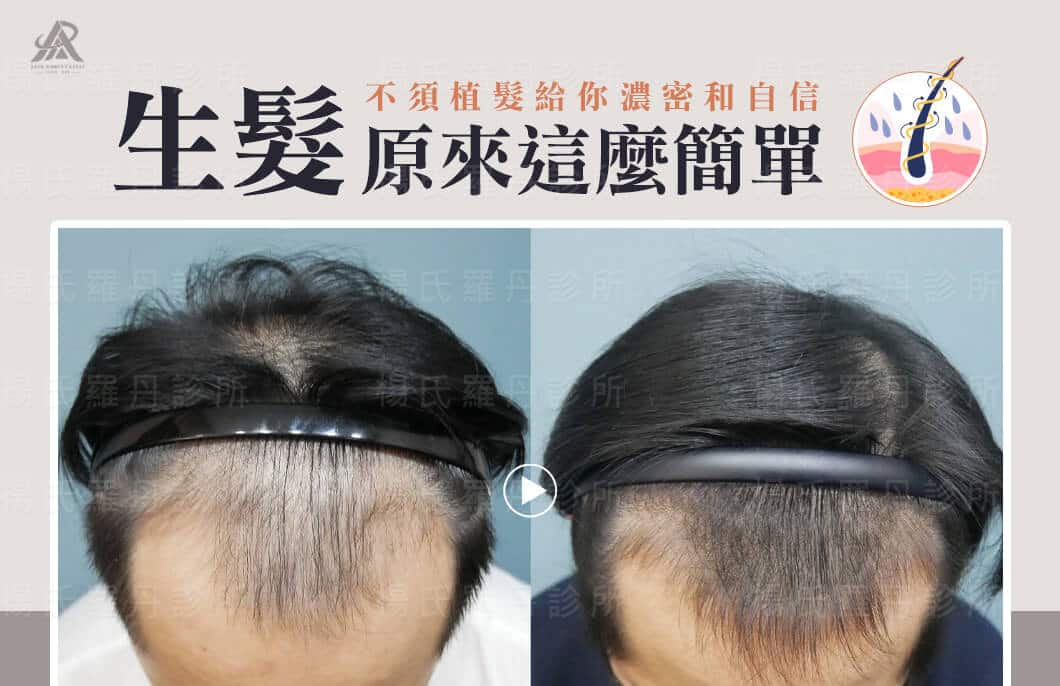 【複合式生髮】生髮原來這麼簡單，不須植髮給你濃密和自信