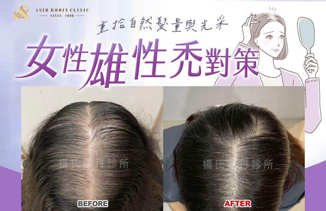 【複合式生髮】女性雄性禿對策，重拾自然髮量與光采！