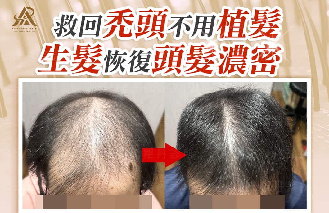 【複合式生髮】救回禿頭不用植髮，生髮恢復頭髮濃密！