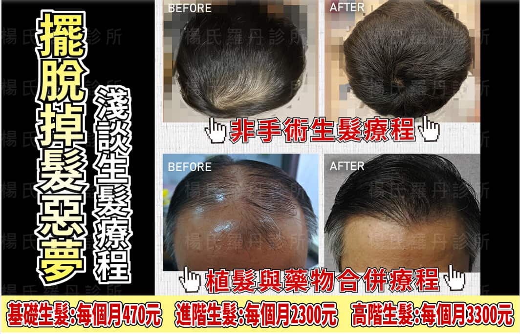 什麼是生髮療程？醫師專業解釋給您聽！