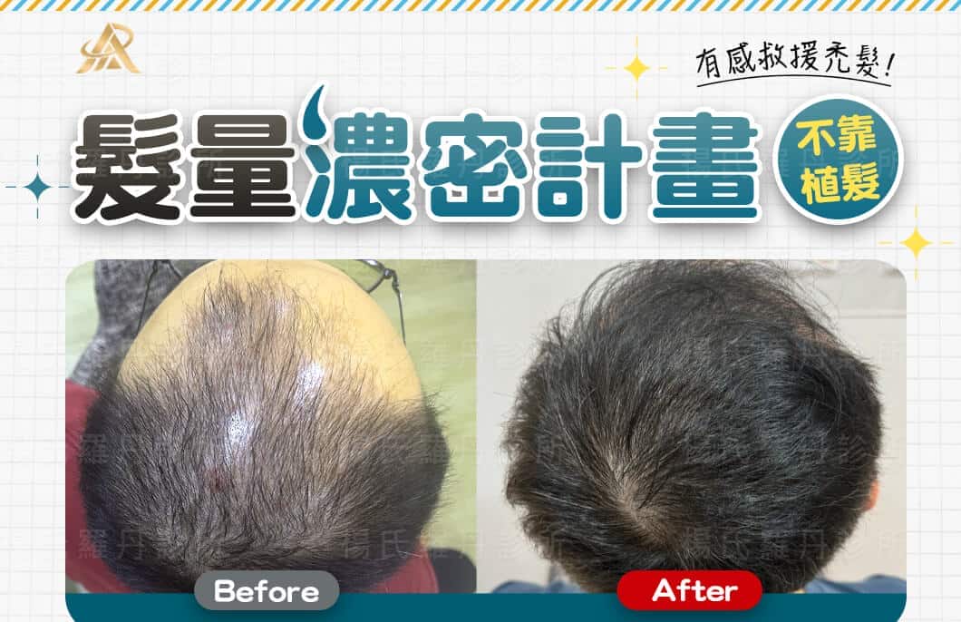 【複合式生髮】髮量濃密計畫，不靠植髮也能有感救援禿髮
