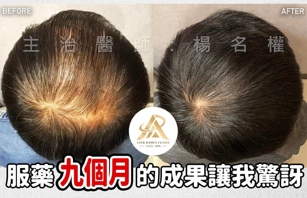 【複合式生髮】服藥九個月的成果讓我驚訝了...