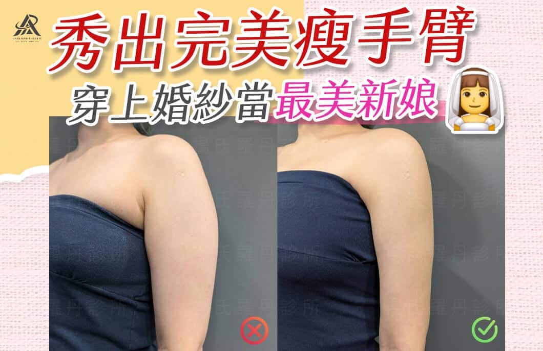 【雷射減脂】婚前秀出完美瘦手臂，穿上婚紗當最美新娘