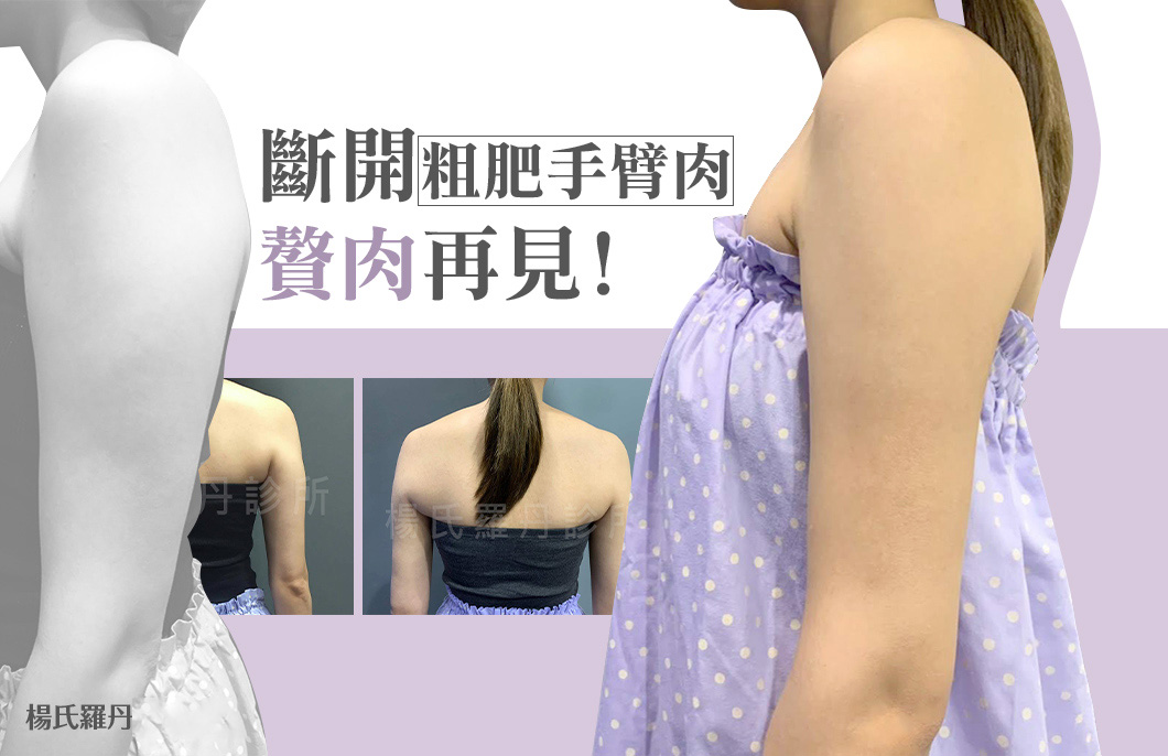 【雷射減脂】斷開粗肥手臂肉，雷射減脂讓贅肉再也不見！