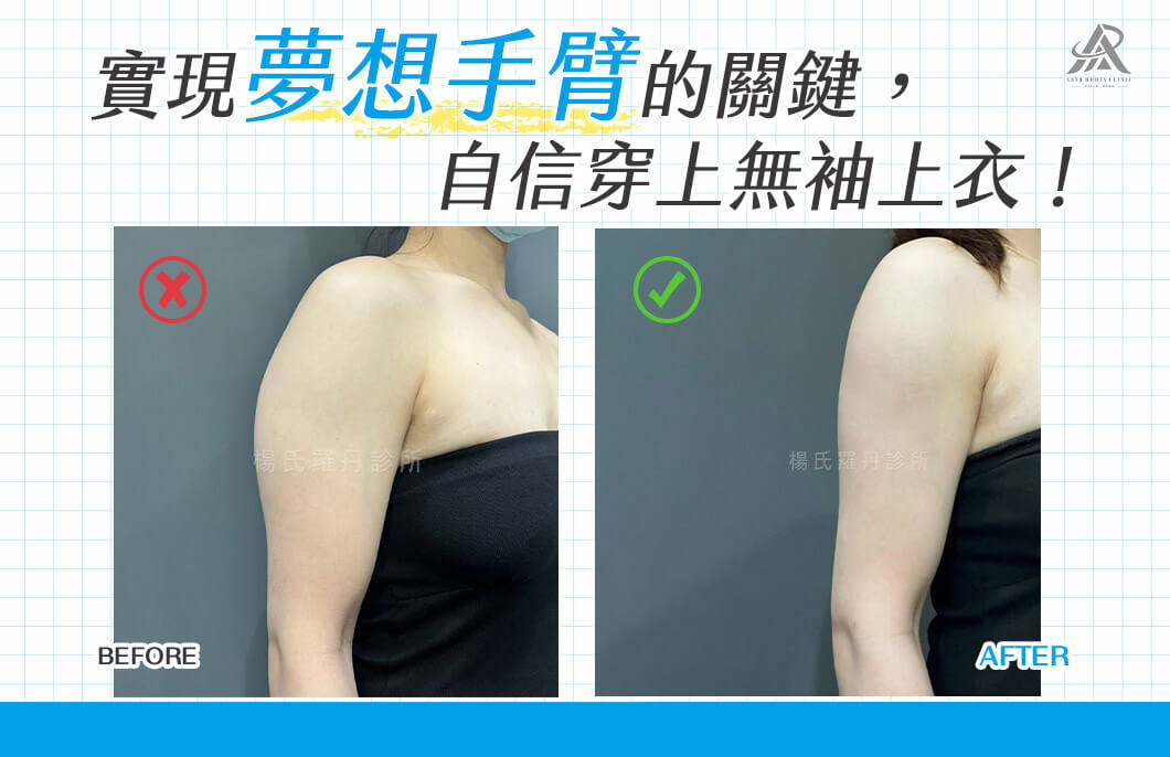 【雷射減脂】實現夢想手臂的關鍵，自信穿上無袖上衣！