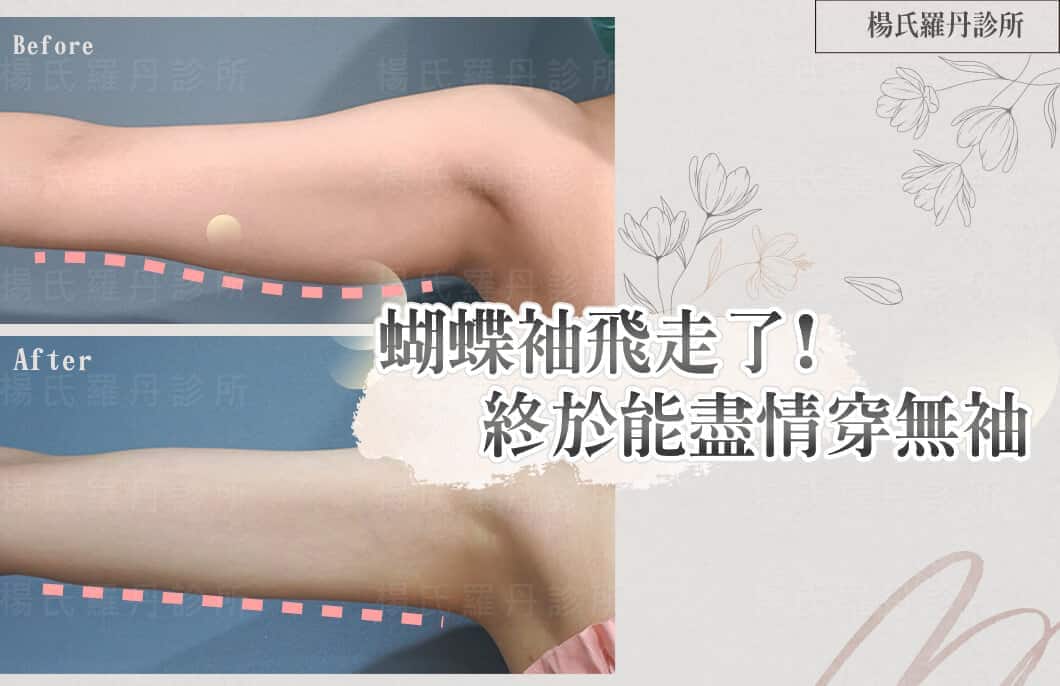 【雷射減脂】多年的蝴蝶袖飛走了!瘦手臂後終於能盡情穿無袖