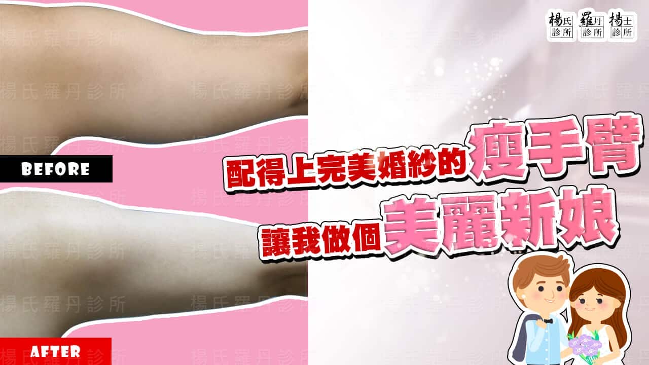 【雷射減脂】配得上完美婚紗的瘦手臂，讓我做個美麗新娘