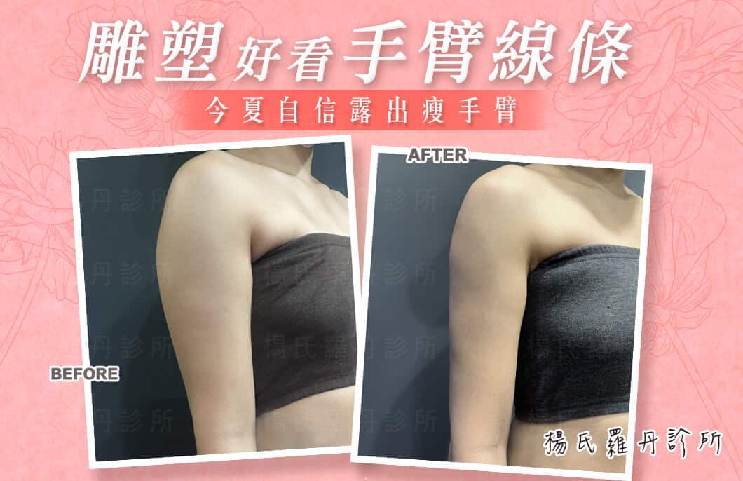 【雷射減脂】雕塑好看手臂線條，今夏自信露出瘦手臂!