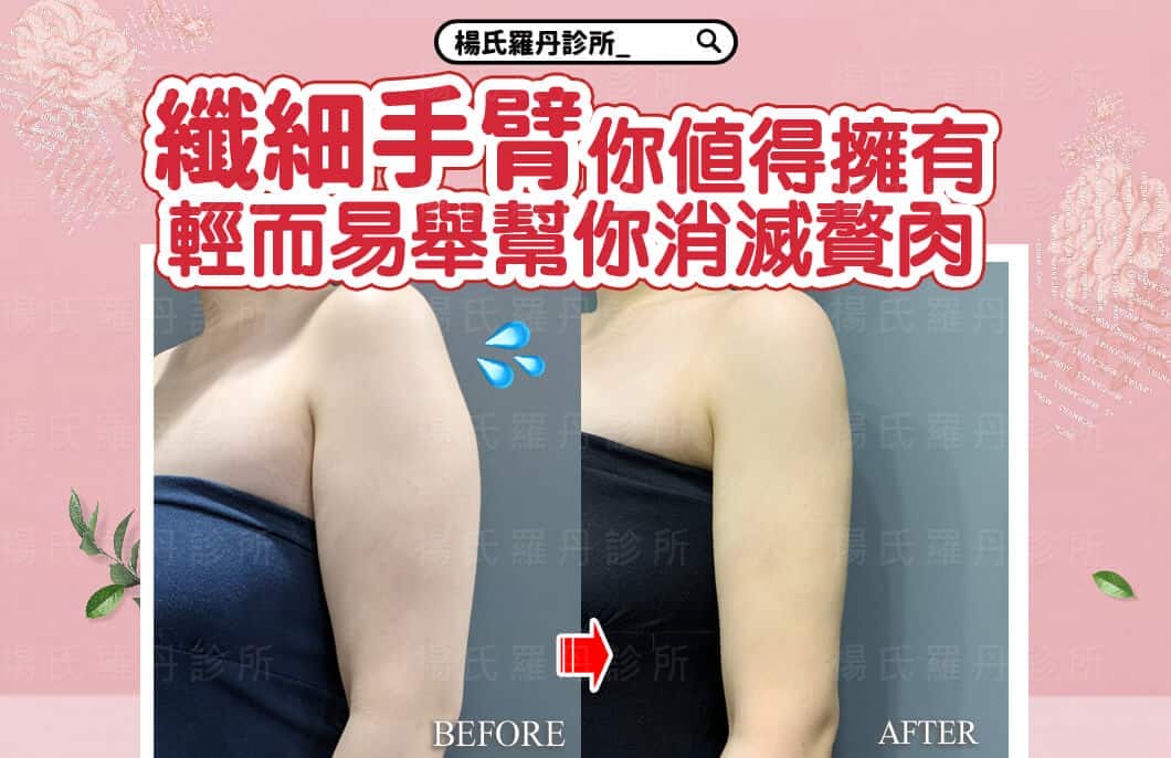 【雷射減脂】纖細手臂你值得擁有，輕而易舉幫你消滅贅肉