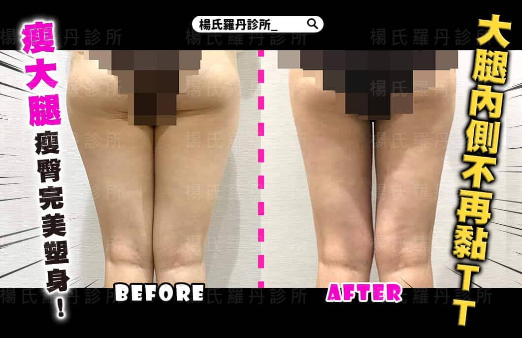【雷射減脂】瘦大腿瘦臀完美塑身！大腿內側不再黏TT