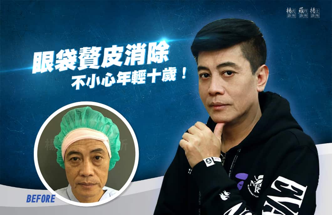 【眼袋淚溝】眼袋贅皮消除，不小心年輕十歲！