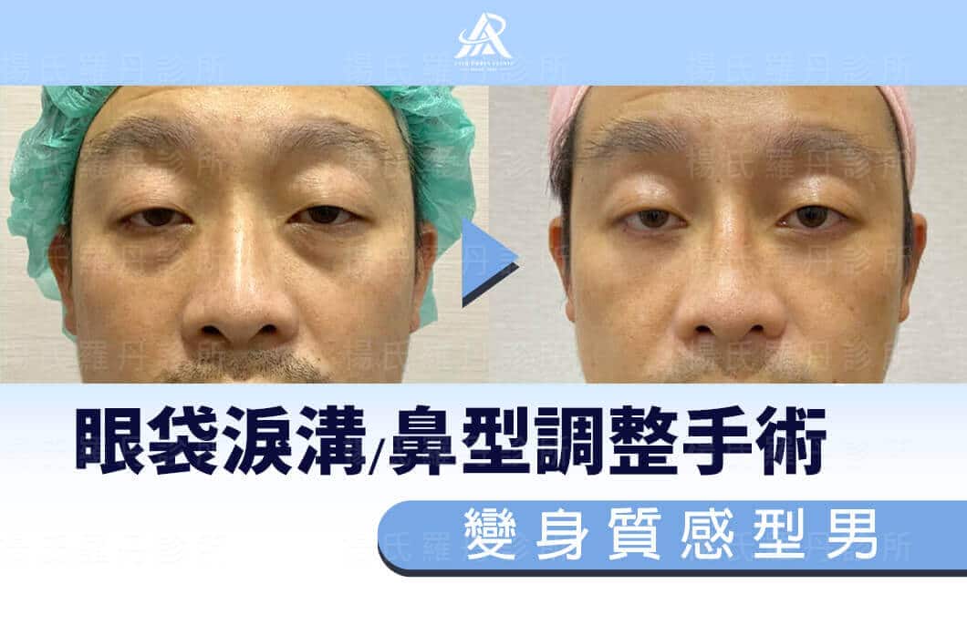 【醫美微整形】眼袋淚溝/鼻型調整手術，變身質感型男！
