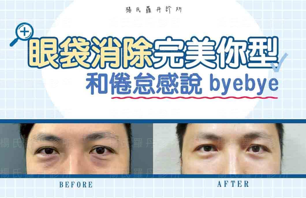 【眼袋淚溝】眼袋消除完美你型，和倦怠感說byebye
