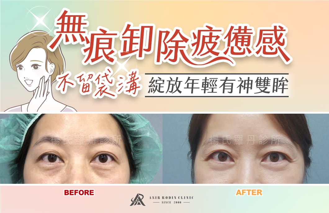 【眼袋淚溝】無痕卸除疲憊感，不留袋溝綻放年輕有神雙眸