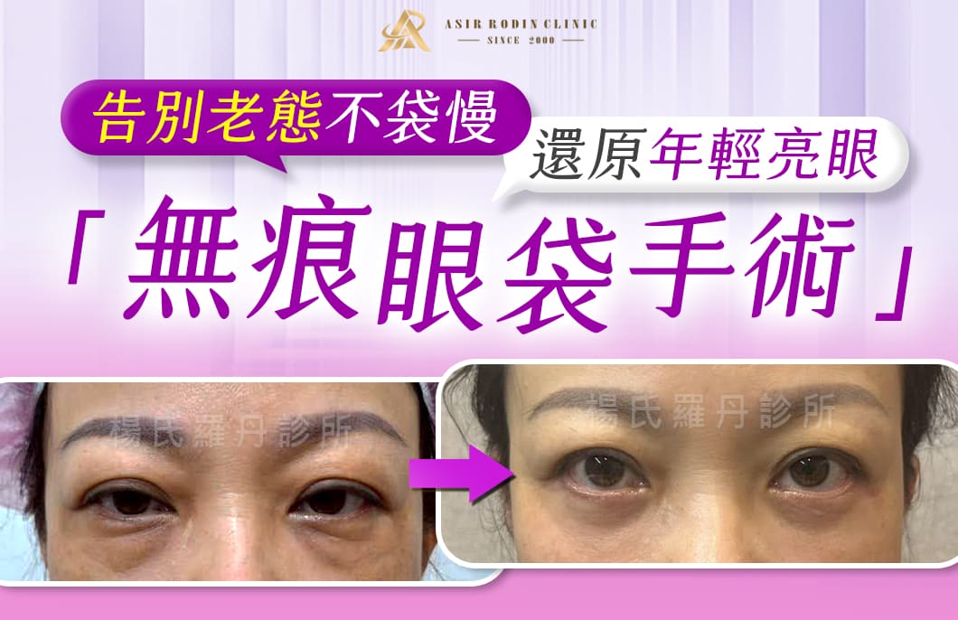 【眼袋淚溝】告別老態不袋慢！無痕眼袋手術還原年輕亮眼