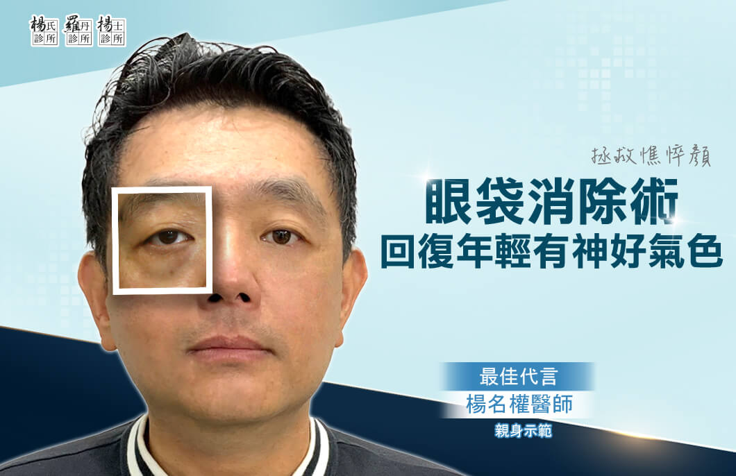 【眼袋淚溝】眼袋消除術拯救憔悴顏，回復年輕有神好氣色