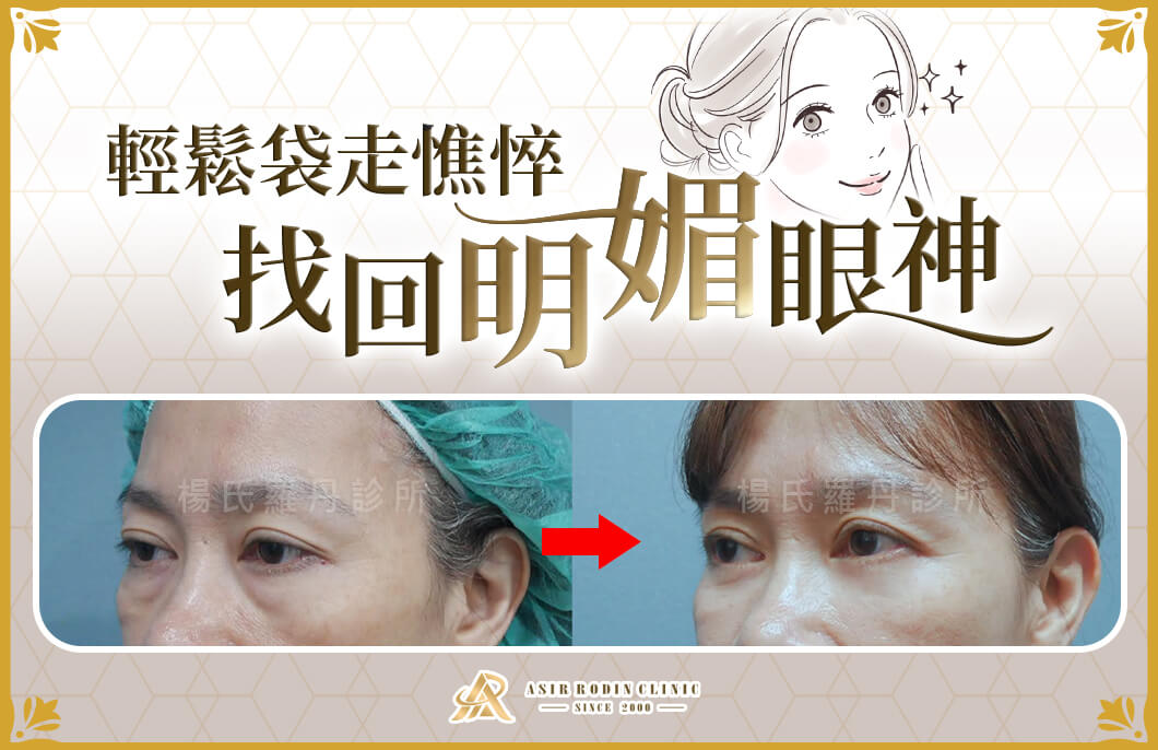 【眼袋淚溝】輕鬆袋走憔悴，找回明媚眼神與自然好氣色