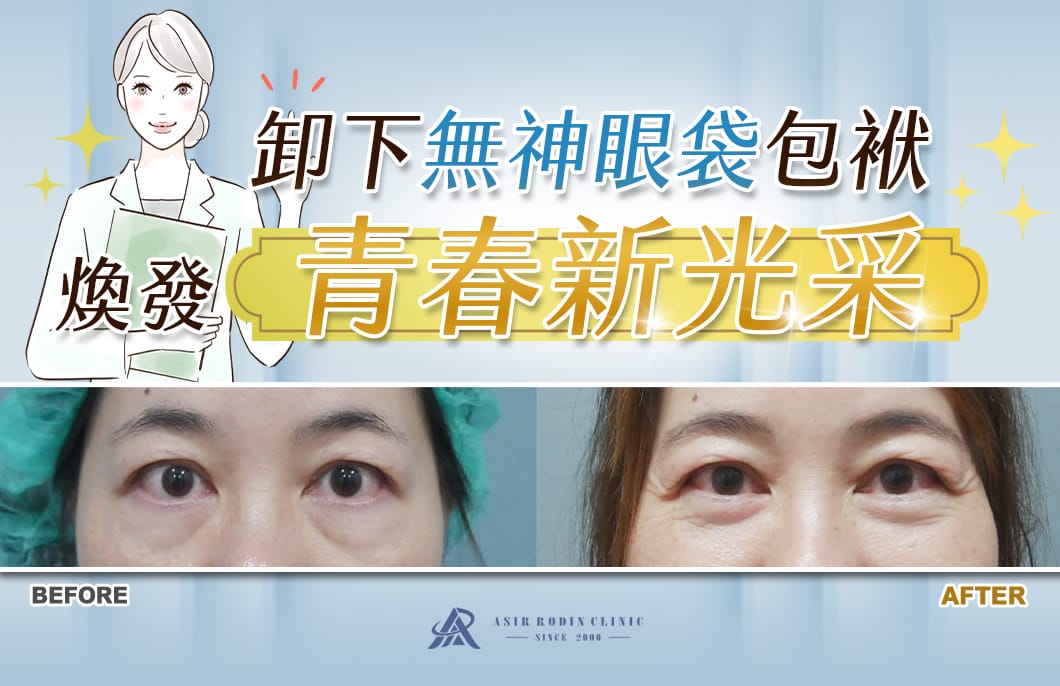 【眼袋淚溝】卸下無神眼袋包袱，煥發眼周青春新光采！