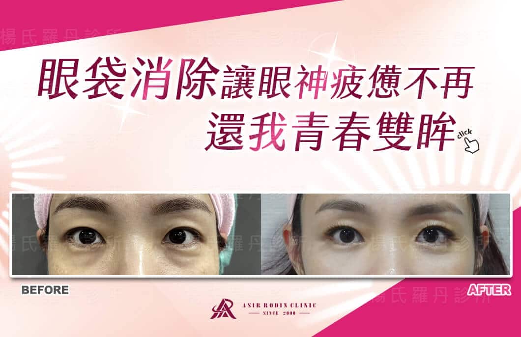 【眼袋淚溝】眼袋消除讓眼神疲憊不再，還我青春雙眸~