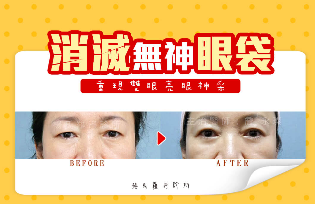 【眼袋淚溝】消滅顯老無神眼袋，重現雙眼年輕亮眼神采