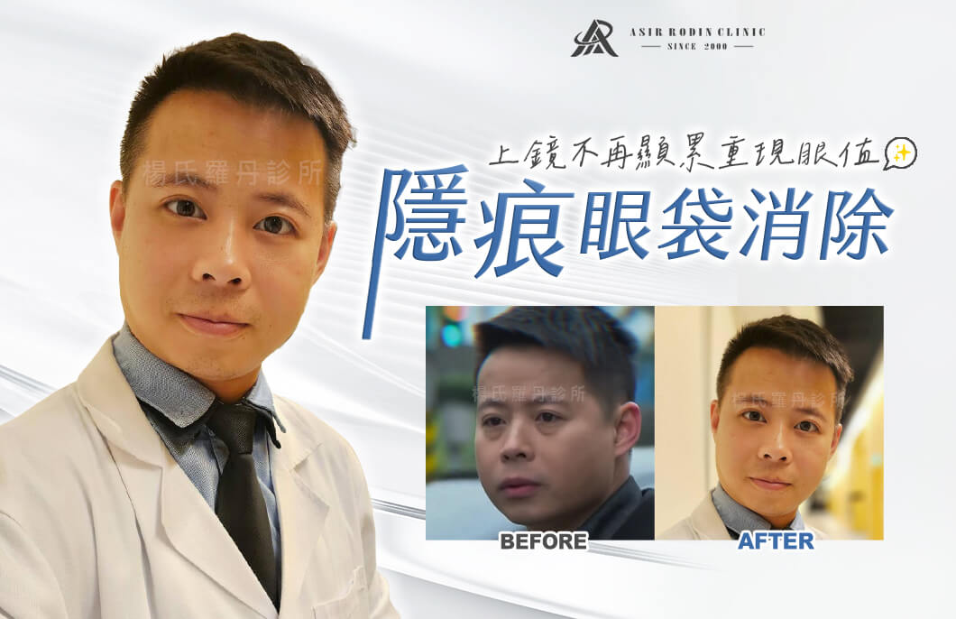 【眼袋淚溝】隱痕眼袋消除，演員上鏡不再顯累，重現少年眼值