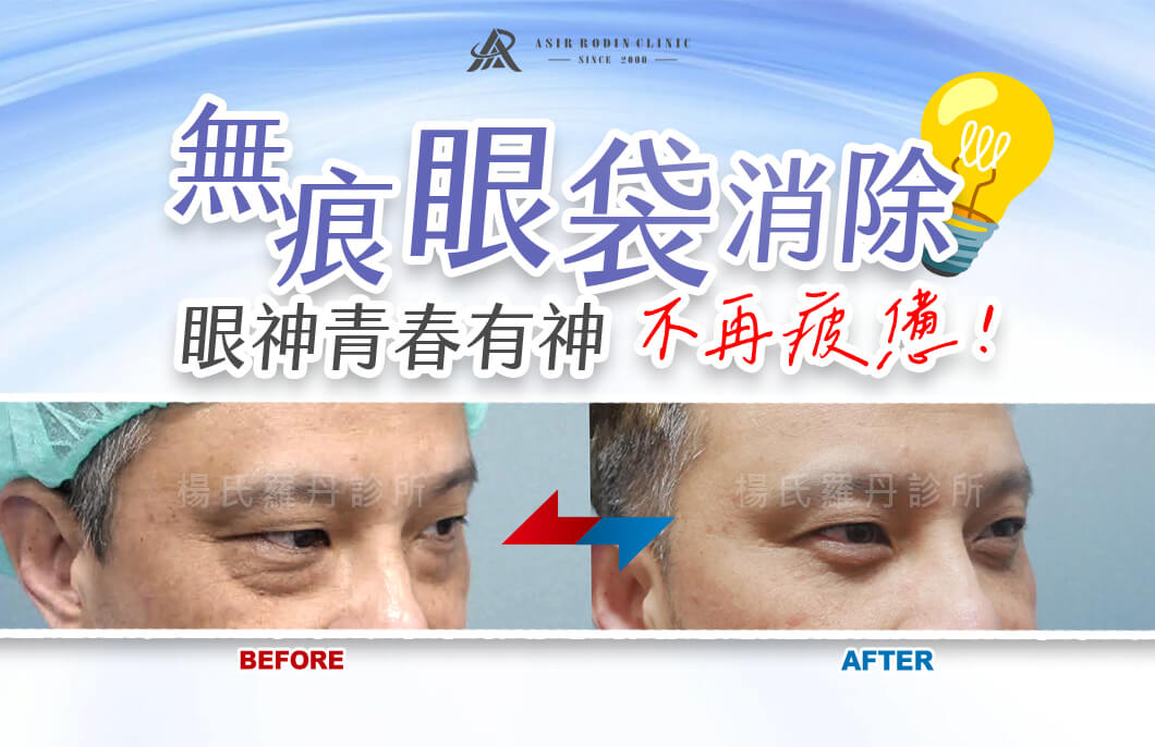 【眼袋淚溝】無痕眼袋消除，讓眼神青春有神不再疲憊！