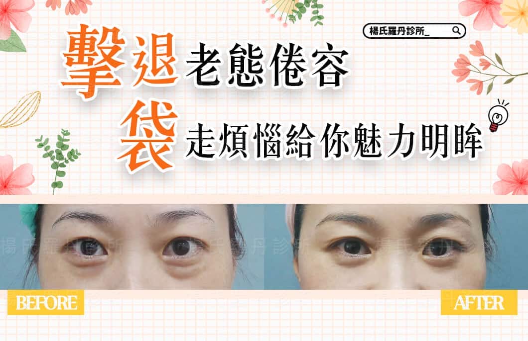【眼袋淚溝】擊退老態倦容，「袋」走煩惱給你魅力明眸