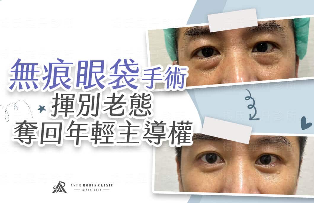 【眼袋淚溝】無痕眼袋手術，揮別老態奪回年輕主導權！