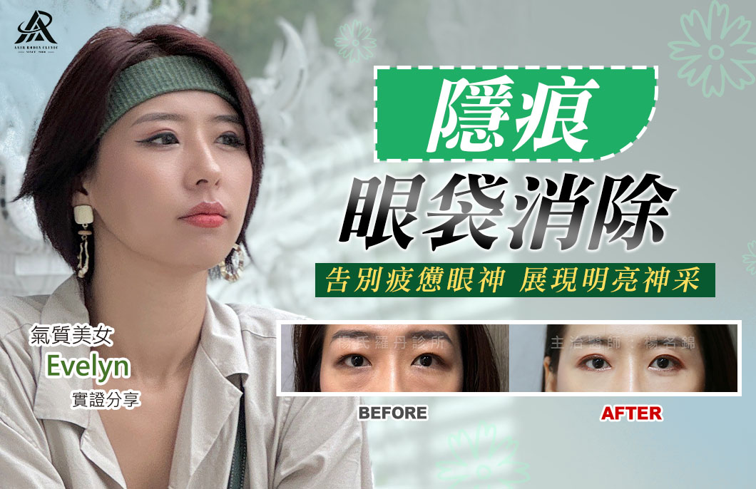【眼袋淚溝】隱痕眼袋消除，告別疲憊眼神展現明亮神采