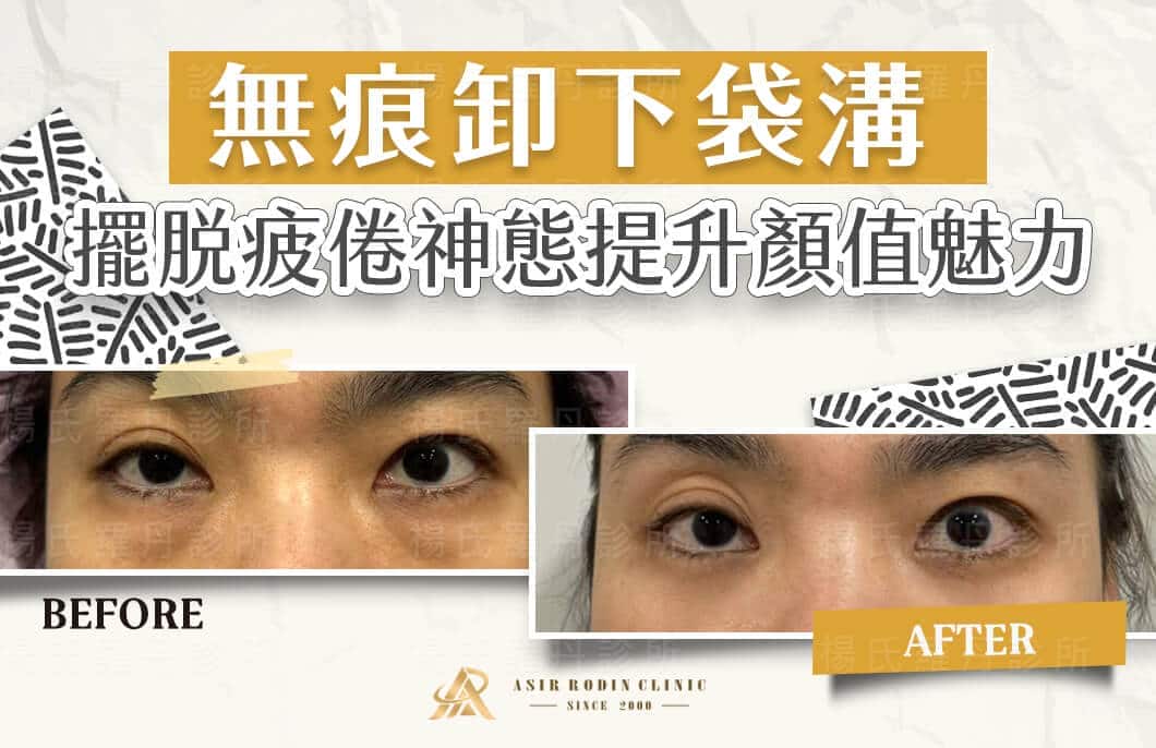 【眼袋淚溝】無痕卸下袋溝，擺脫疲倦神態提升顏值魅力
