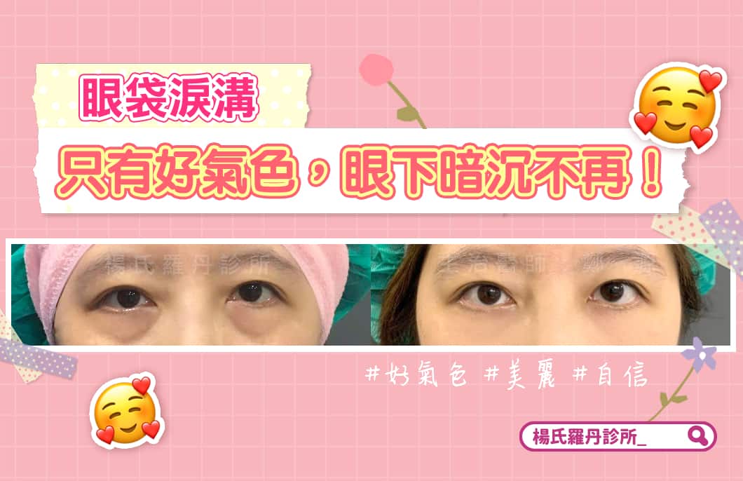 【眼袋淚溝】只有好氣色，眼下暗沉不再！