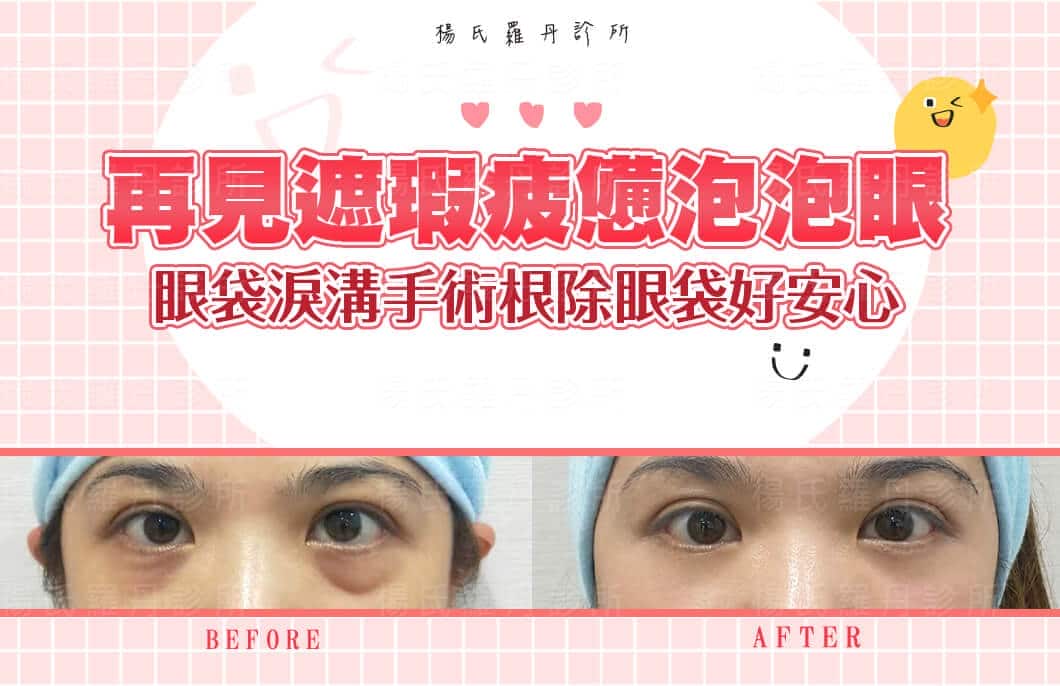 【眼袋淚溝】再見遮瑕疲憊泡泡眼，眼袋淚溝手術根除眼袋好安心