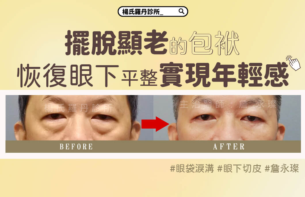 【眼袋淚溝】擺脫顯老的包袱，恢復眼下平整實現年輕感