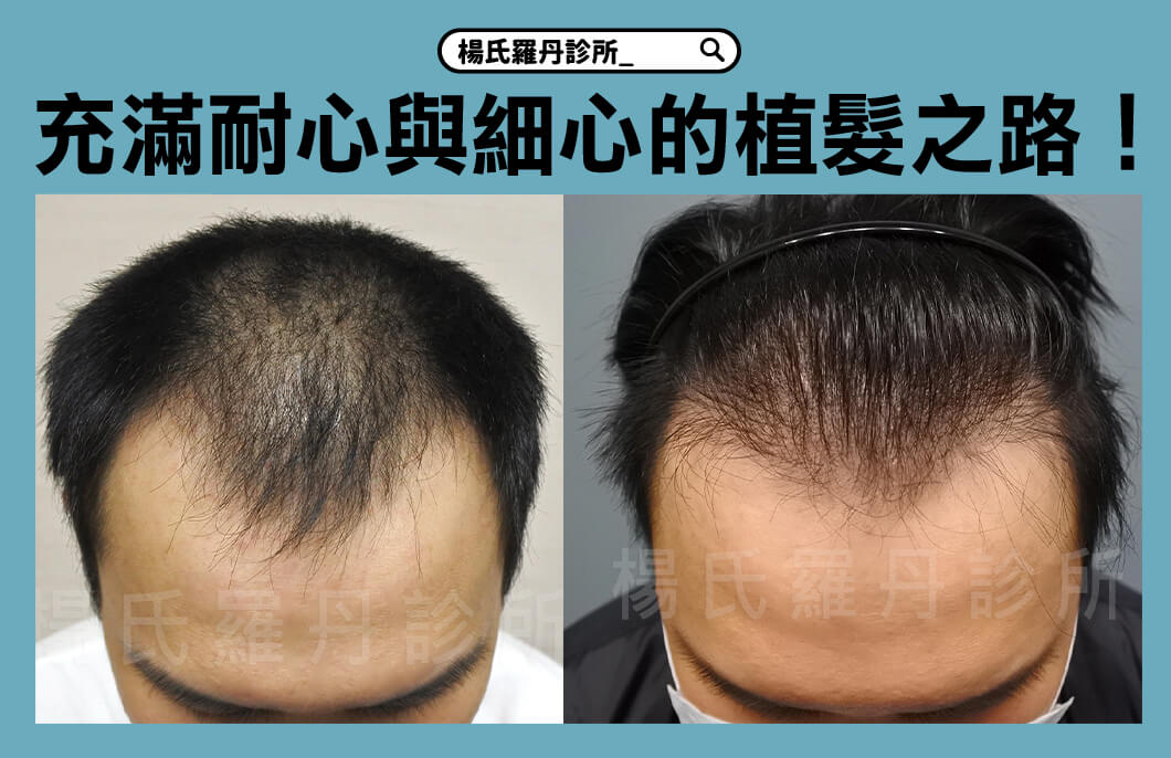 【植髮】某天落髮找上我，開啟了充滿耐心與細心的植髮之路