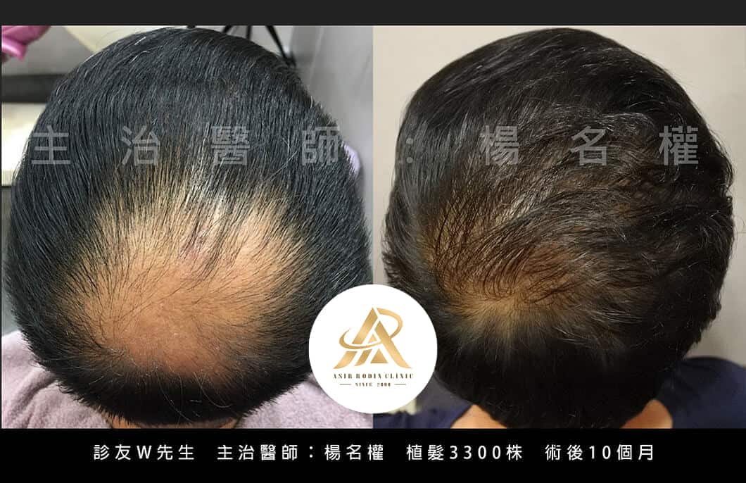 【植髮】楊名權醫師：愛美是天性！
