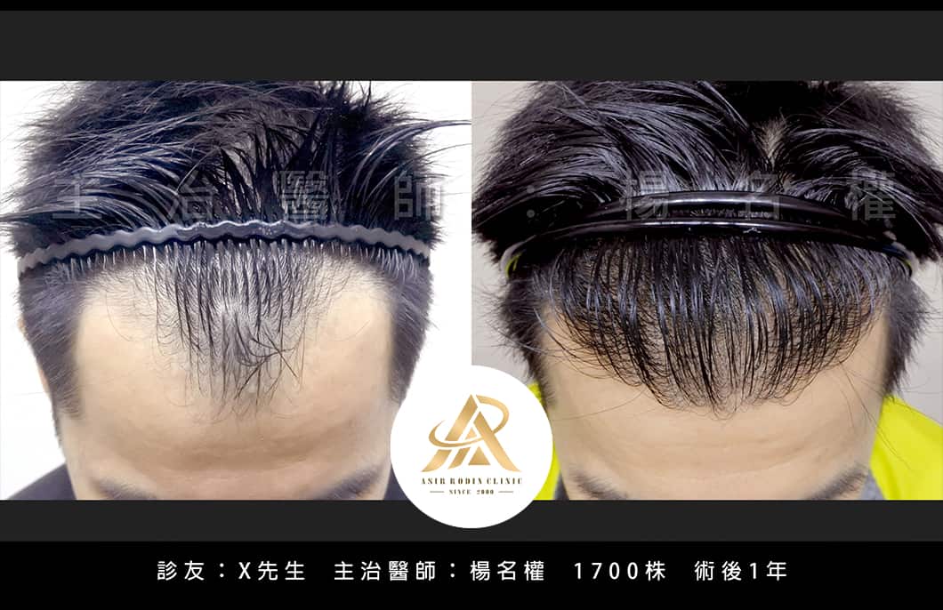 【植髮】楊名權醫師：追求完美的回報是甜蜜的！