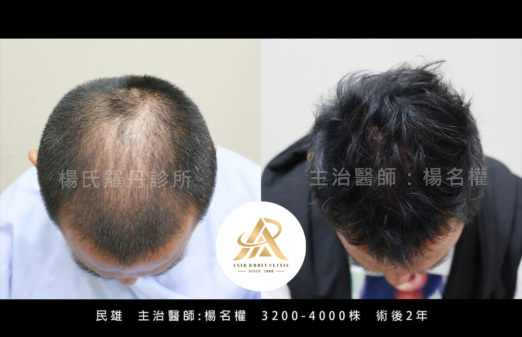【植髮】不讓雄性禿有損帥氣，你「植」得十個月的等待！